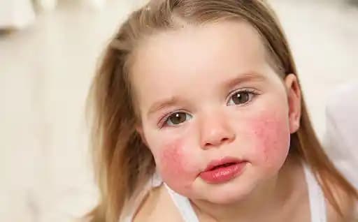 Duştan Sonra Yüz Kızarması Nedenleri ve Etkili Çözüm Yolları Hakkında Bilmeniz Gerekenler