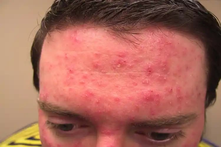 E Vitamini ve Sivilceler: Cilt Sağlığına Etkileri ve Doğru Kullanım Yöntemleri