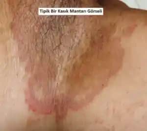 Egzama Genital Bölge ve Kozmetik Yaklaşımlar: Belirtiler, Tedavi ve Bakım İpuçları