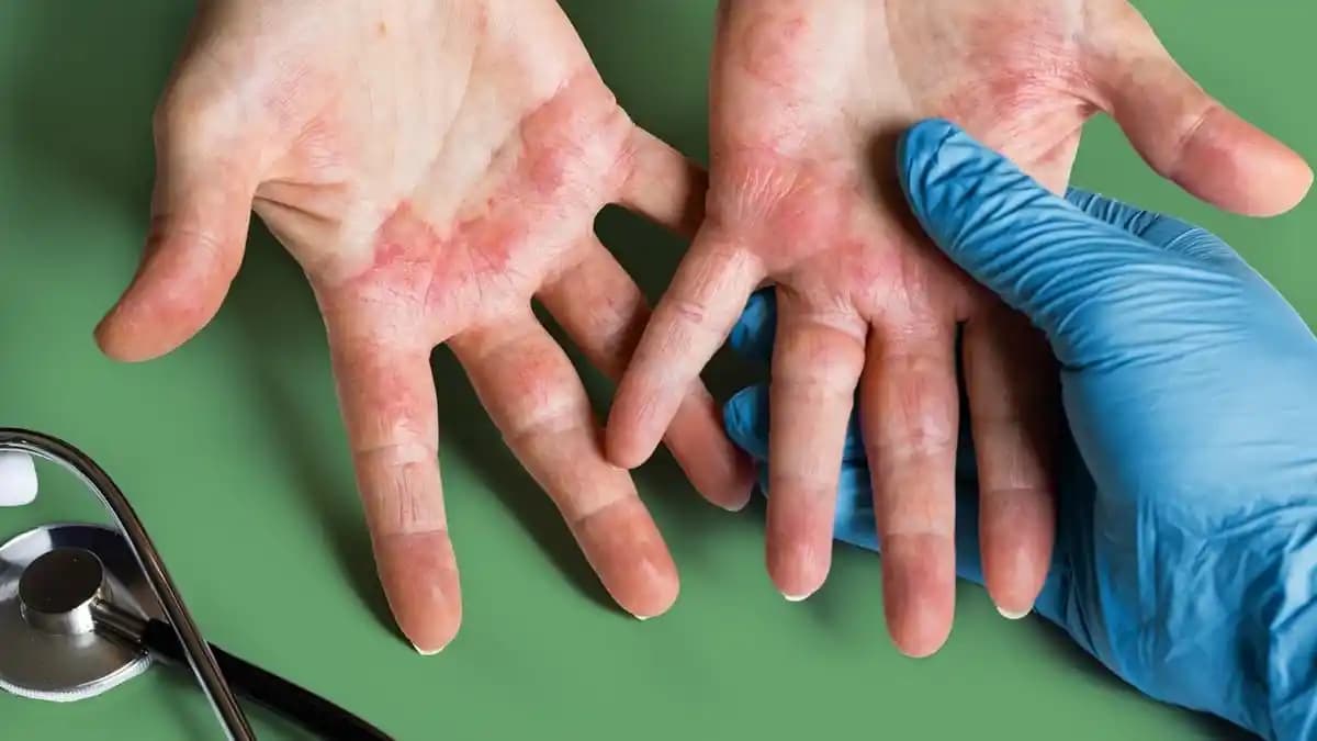 Egzama Sebepleri ve Cilt Sağlığını Koruma Yöntemleri Hakkında Detaylı Bilgi