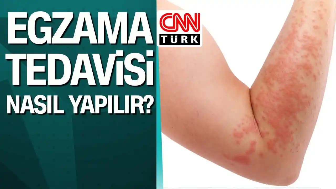 Egzama Tedavisinde Güncel Yöntemler ve Cilt Sağlığını Korumak İçin İpuçları