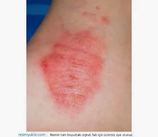 Egzama Türleri ve Doğru Kozmetik Yaklaşımlarıyla Cilt Sağlığını Koruma Rehberi