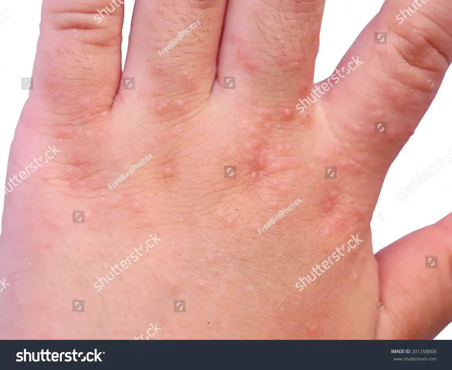 Egzama ve Alerji ile Mücadelede Güvenli Kozmetik Seçenekleri ve Cilt Bakımı İpuçları