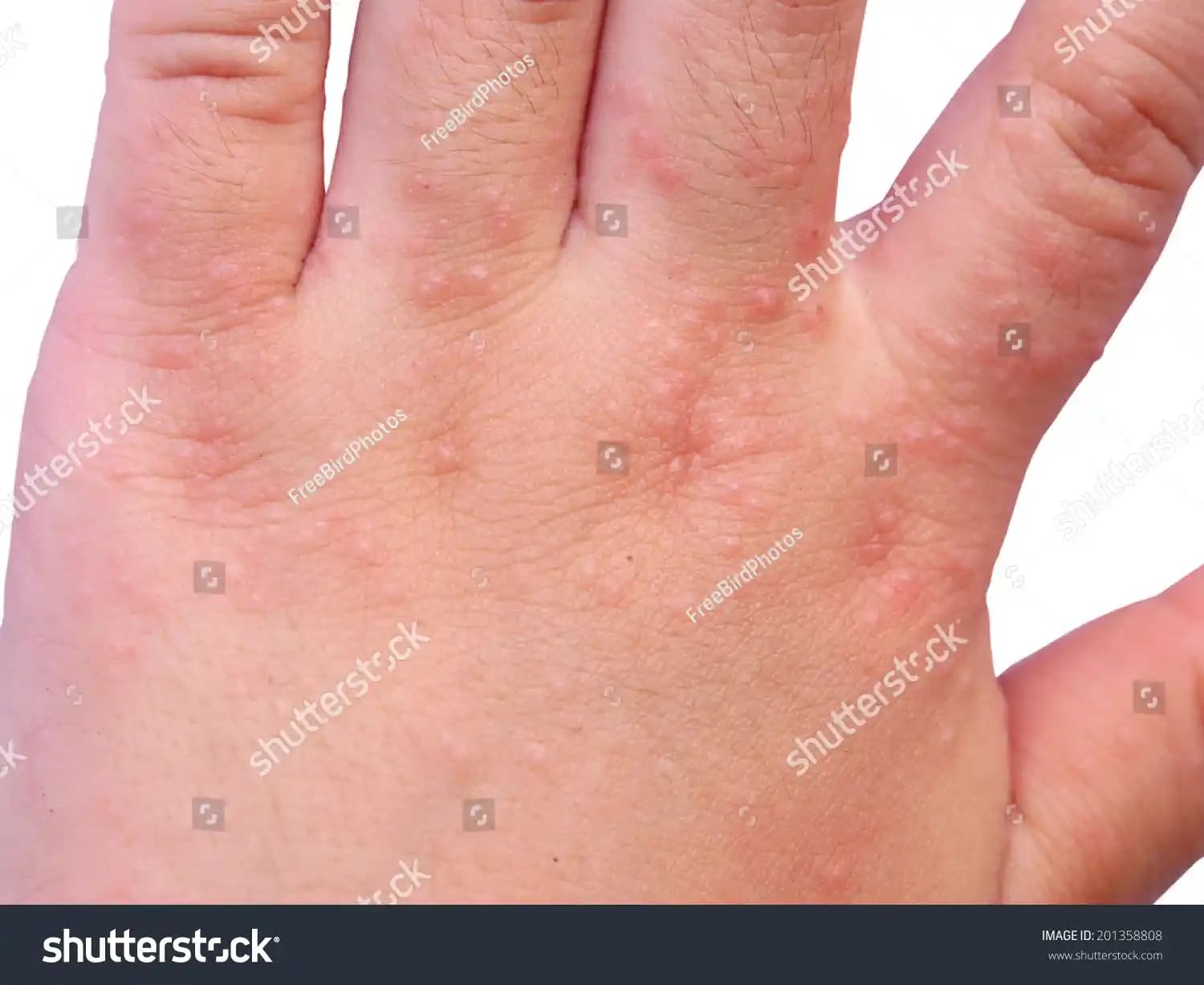 Egzama ve Alerji ile Mücadelede Güvenli Kozmetik Seçenekleri ve Cilt Bakımı İpuçları