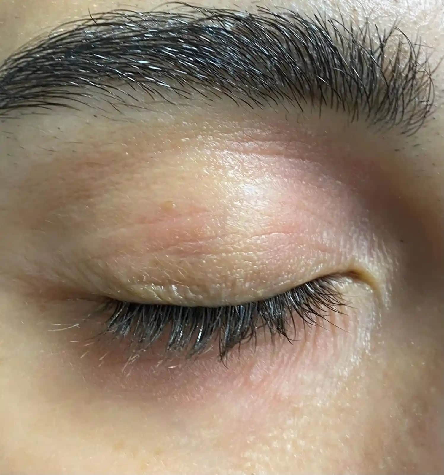 Egzama ve Kızarıklık Sorunlarına Yönelik Kozmetik Çözümler ve Cilt Bakım Rehberi