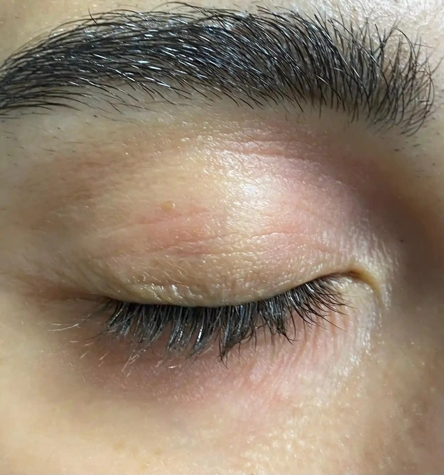 Egzama ve Kızarıklık Sorunlarına Yönelik Kozmetik Çözümler ve Cilt Bakım Rehberi