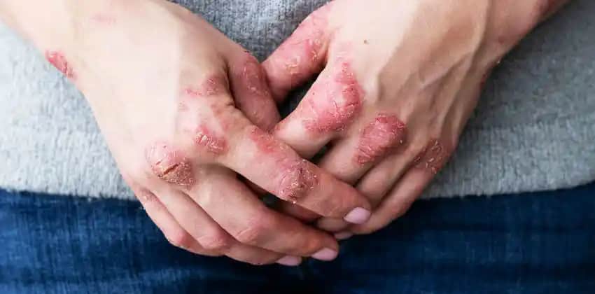 Egzama ve Kozmetik Ürünlerin Cilt Sağlığı Üzerindeki Etkileri Analizi