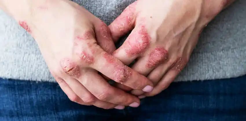 Egzama ve Kozmetik Ürünlerin Cilt Sağlığı Üzerindeki Etkileri Analizi