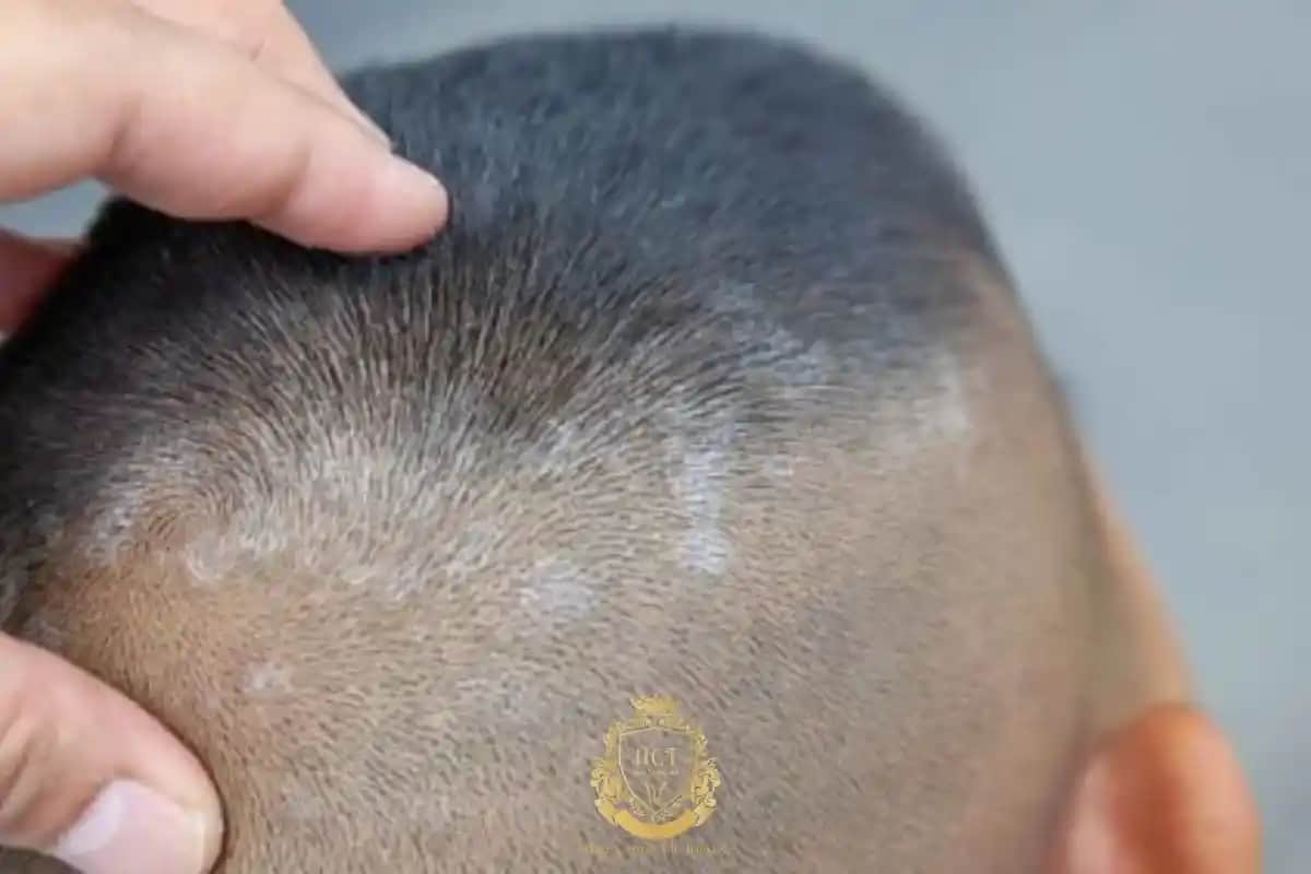 Egzama ve Saç Dökülmesi: Sağlıklı Saçlar İçin Bilinçli Yaklaşımlar ve Önlemler