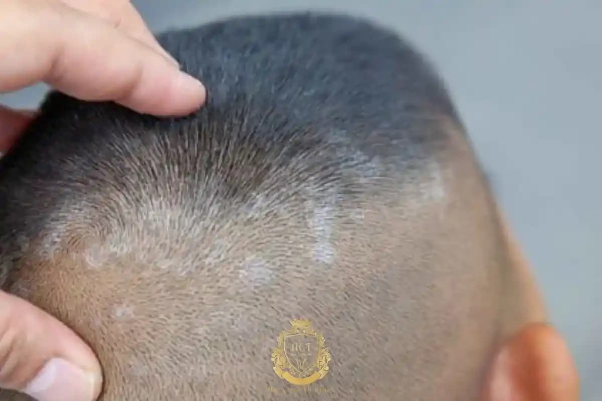 Egzama ve Saç Dökülmesi: Sağlıklı Saçlar İçin Bilinçli Yaklaşımlar ve Önlemler