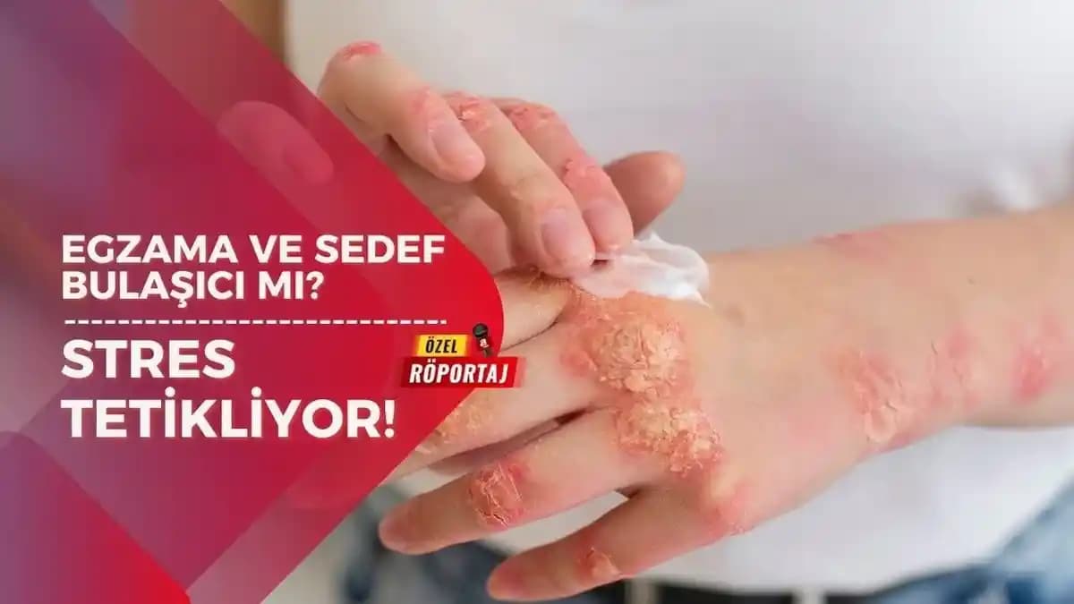 Egzama ve Sedef Hastalığının Ayırıcı Tanısı: Klinik Özellikler ve Tanı Yöntemleri