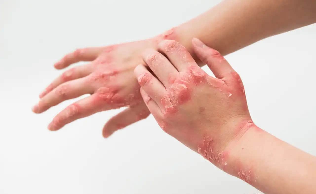 Egzama ve Stres İlişkisi: Doğal Çözüm Yolları ve Cilt Sağlığı İpuçları