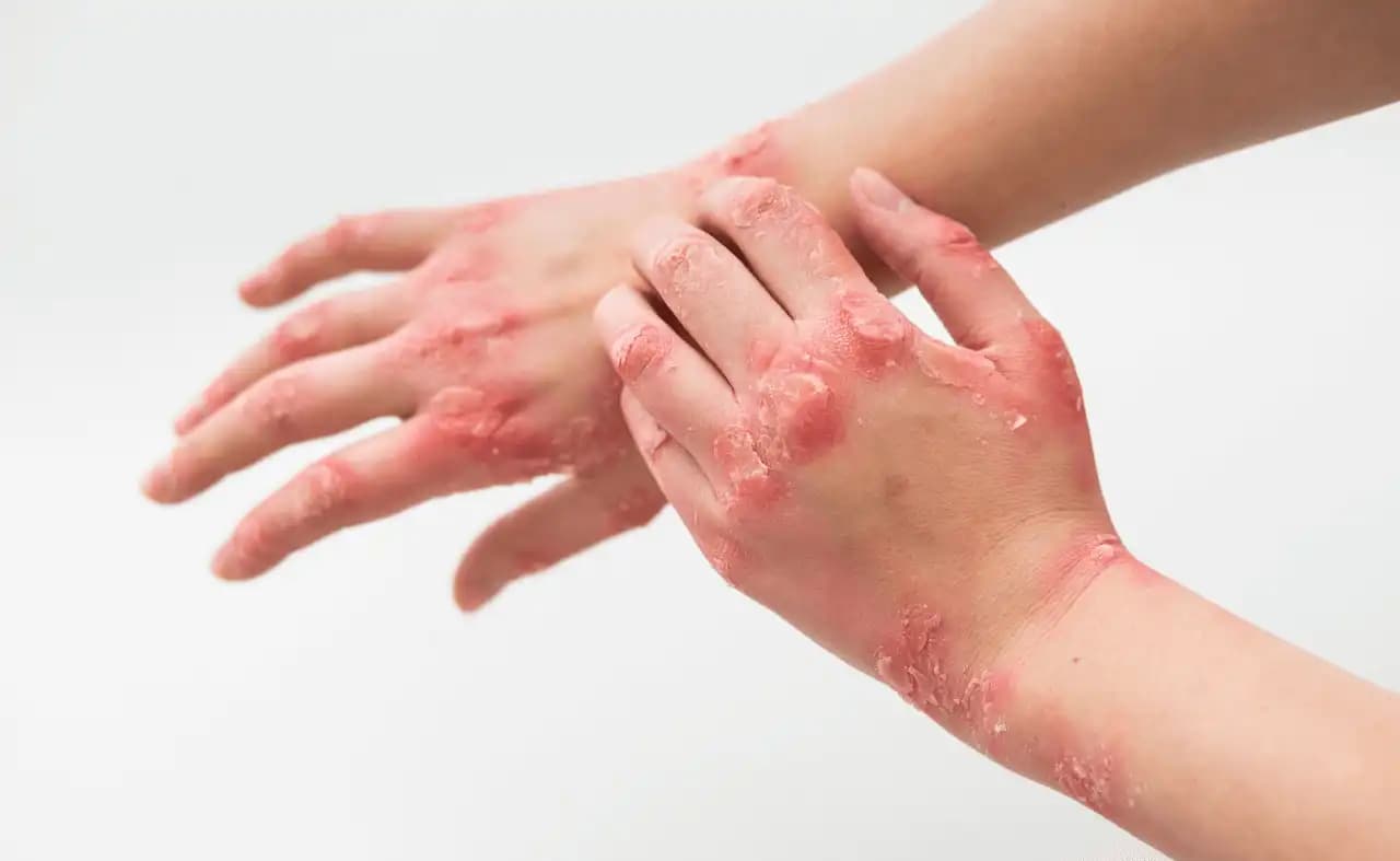 Egzama ve Stres İlişkisi: Doğal Çözüm Yolları ve Cilt Sağlığı İpuçları