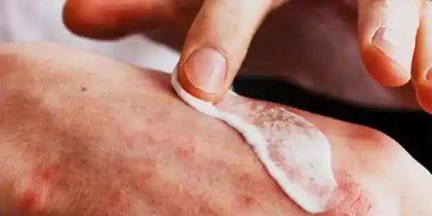 Egzama Yaraları ve Cilt Sağlığını Koruma Yöntemleri Hakkında Detaylı Bilgi