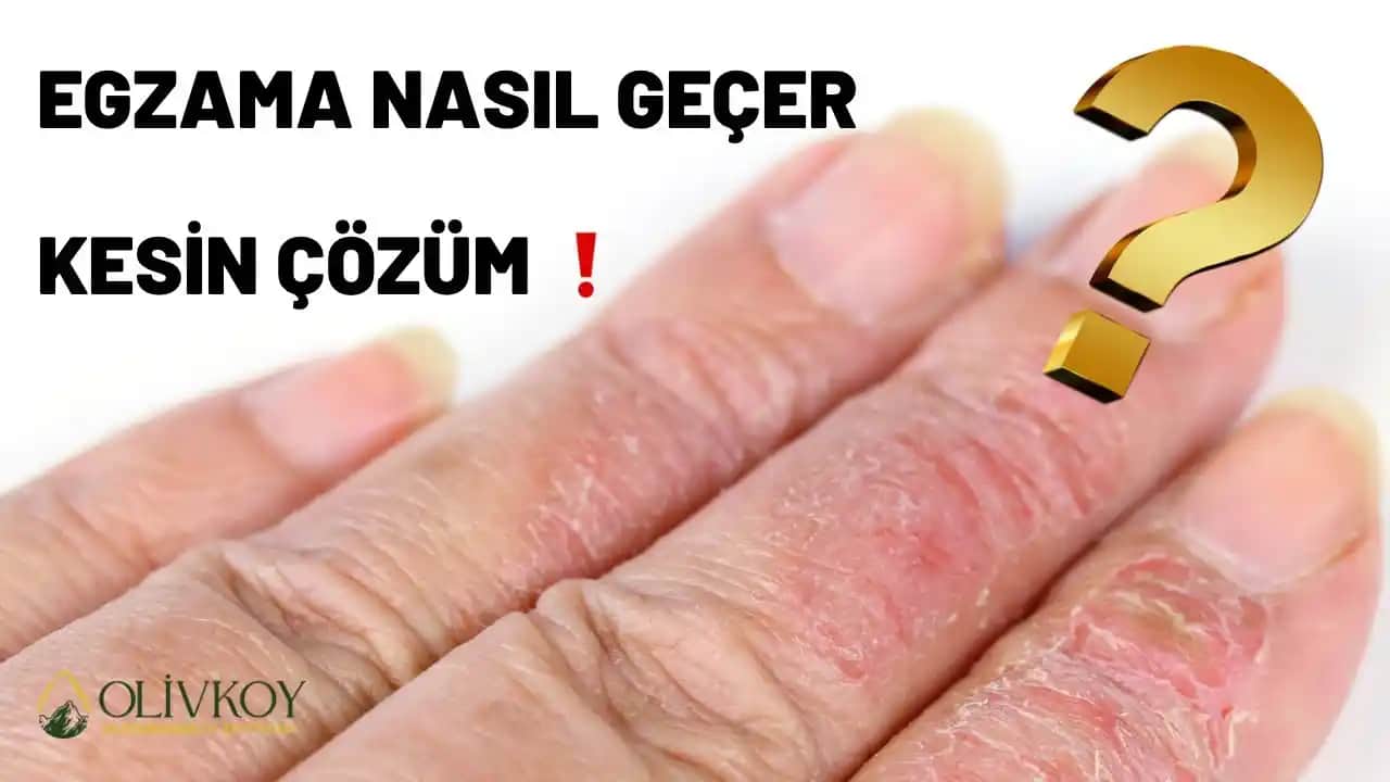 Egzamada Zeytinyağı Kullanımı: Etkileri ve Doğru Yaklaşımlar Hakkında Bilgiler