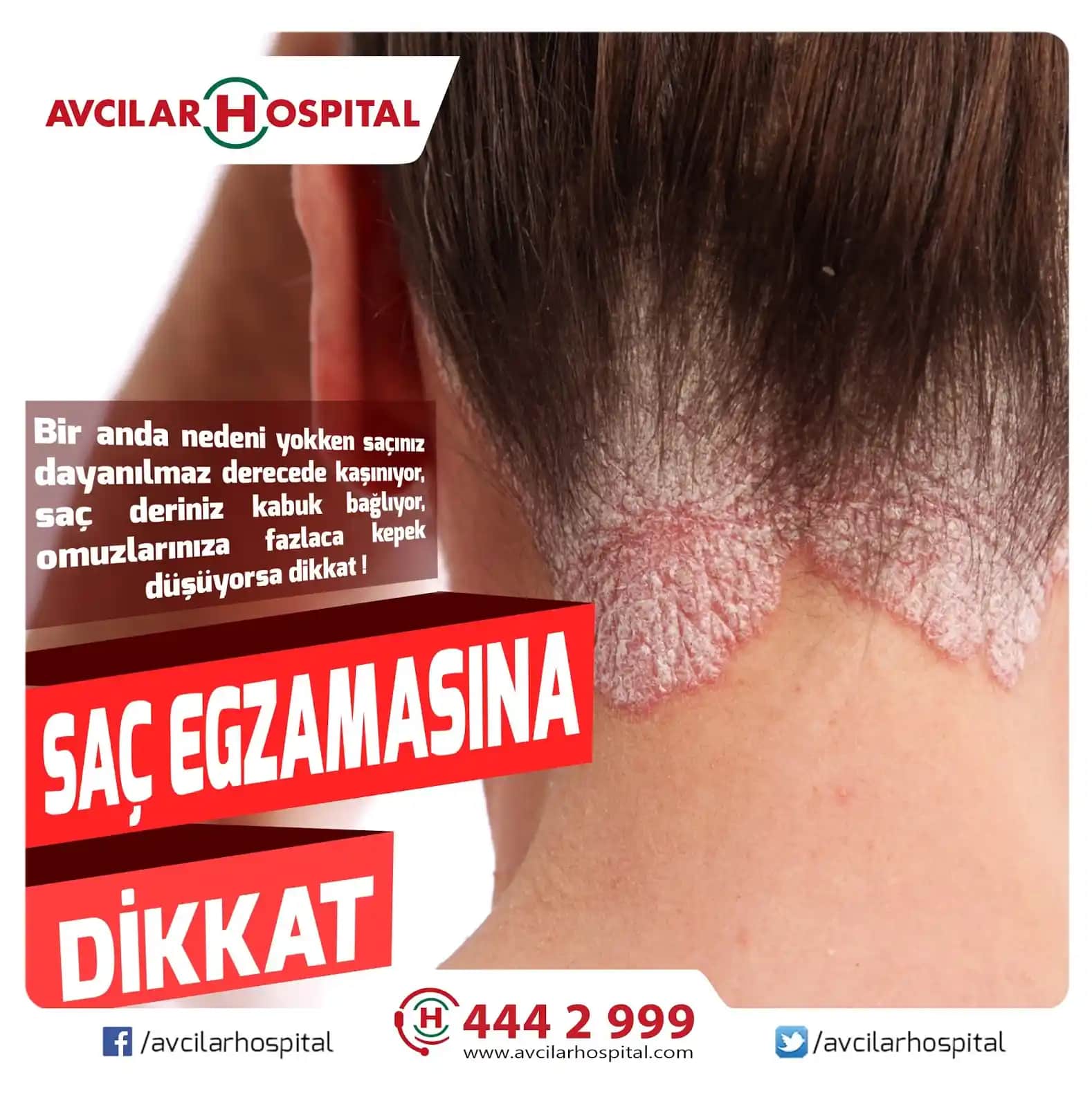 Egzamalı Saçlar İçin En İyi Bakım Yöntemleri ve Doğal Çözüm Önerileri