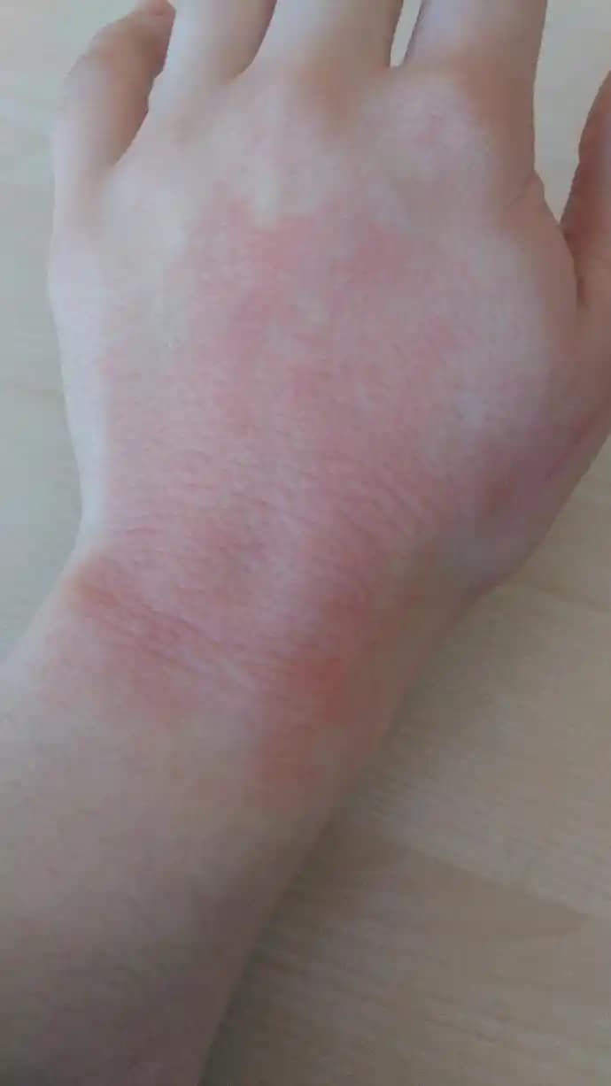 El Üstü Kızarıklığı ve Kozmetik Kullanımı: Nedenleri ve Çözüm Yolları