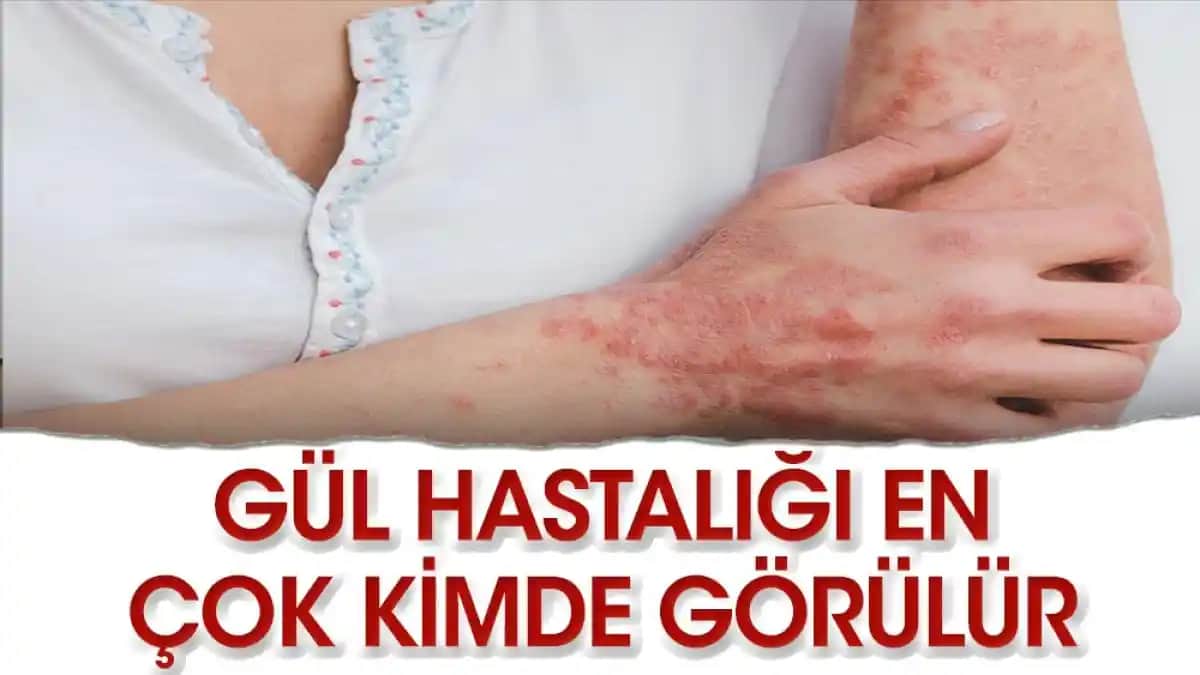 Elde Gül Hastalığı ve Kozmetik Bakımda Etkili Çözüm Yolları