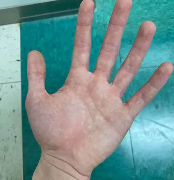 Elde Kızarıklığının Nedenleri ve Çözüm Yolları Hakkında Detaylı Bilgi