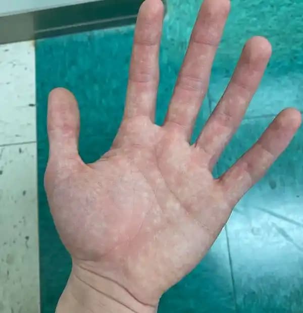 Elde Kızarıklığının Nedenleri ve Çözüm Yolları Hakkında Detaylı Bilgi