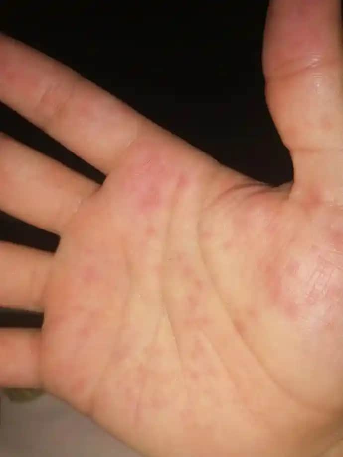 Elde Küçük Kırmızı Noktaların Nedenleri ve Doğru Cilt Bakım Yöntemleri