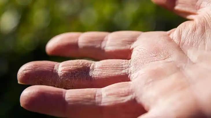 Elde Kuruluğu Nedenleri ve Etkili Çözüm Yolları Hakkında Bilmeniz Gerekenler