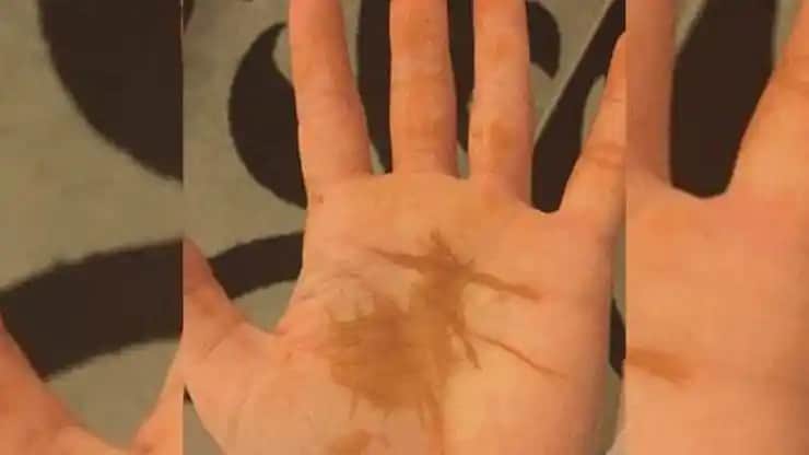 Elde Lekeleri Neden Oluşur ve Etkili Tedavi Yöntemleri Nelerdir