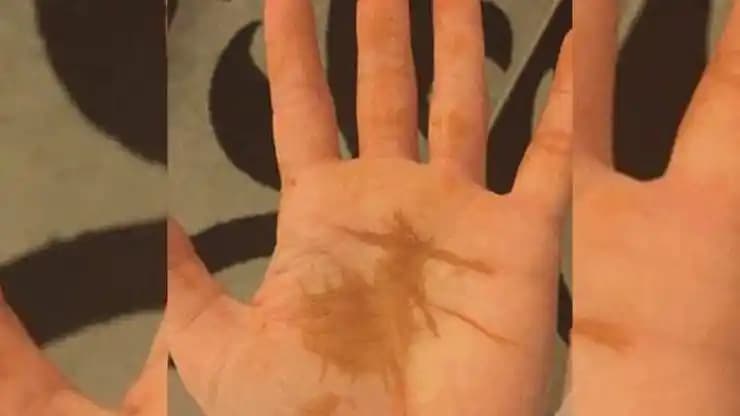 Elde Lekeleri Neden Oluşur ve Etkili Tedavi Yöntemleri Nelerdir