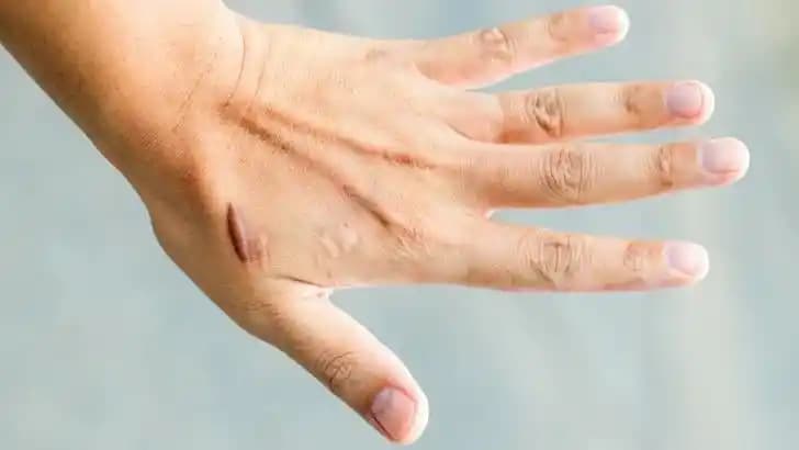 Elde Yara İyileşme Süreci ve Doğru Bakım Yöntemleri Hakkında Detaylı Rehber