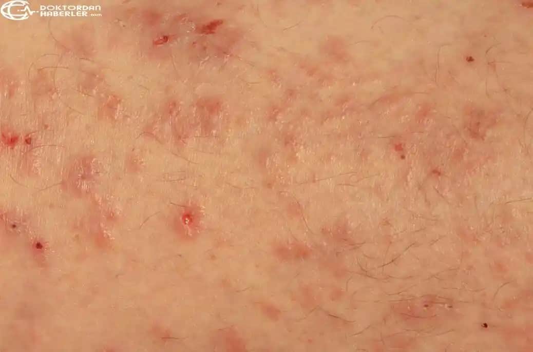 Erkeklerde Genital Bölge Mantar Enfeksiyonlarının Nedenleri ve Korunma Yolları