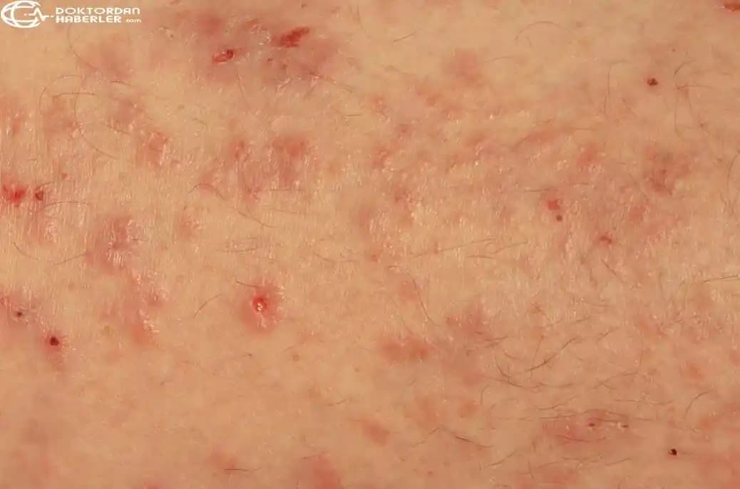 Erkeklerde Genital Bölge Mantar Enfeksiyonlarının Nedenleri ve Korunma Yolları