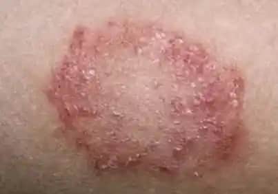 Erkeklerde Mantar Enfeksiyonu: Belirtileri, Tedavi Yöntemleri ve Hijyen Tavsiyeleri