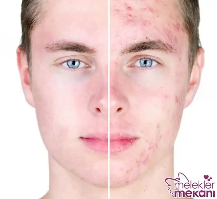 Erkeklerde Sivilce Nedenleri ve Cilt Bakımı İpuçları