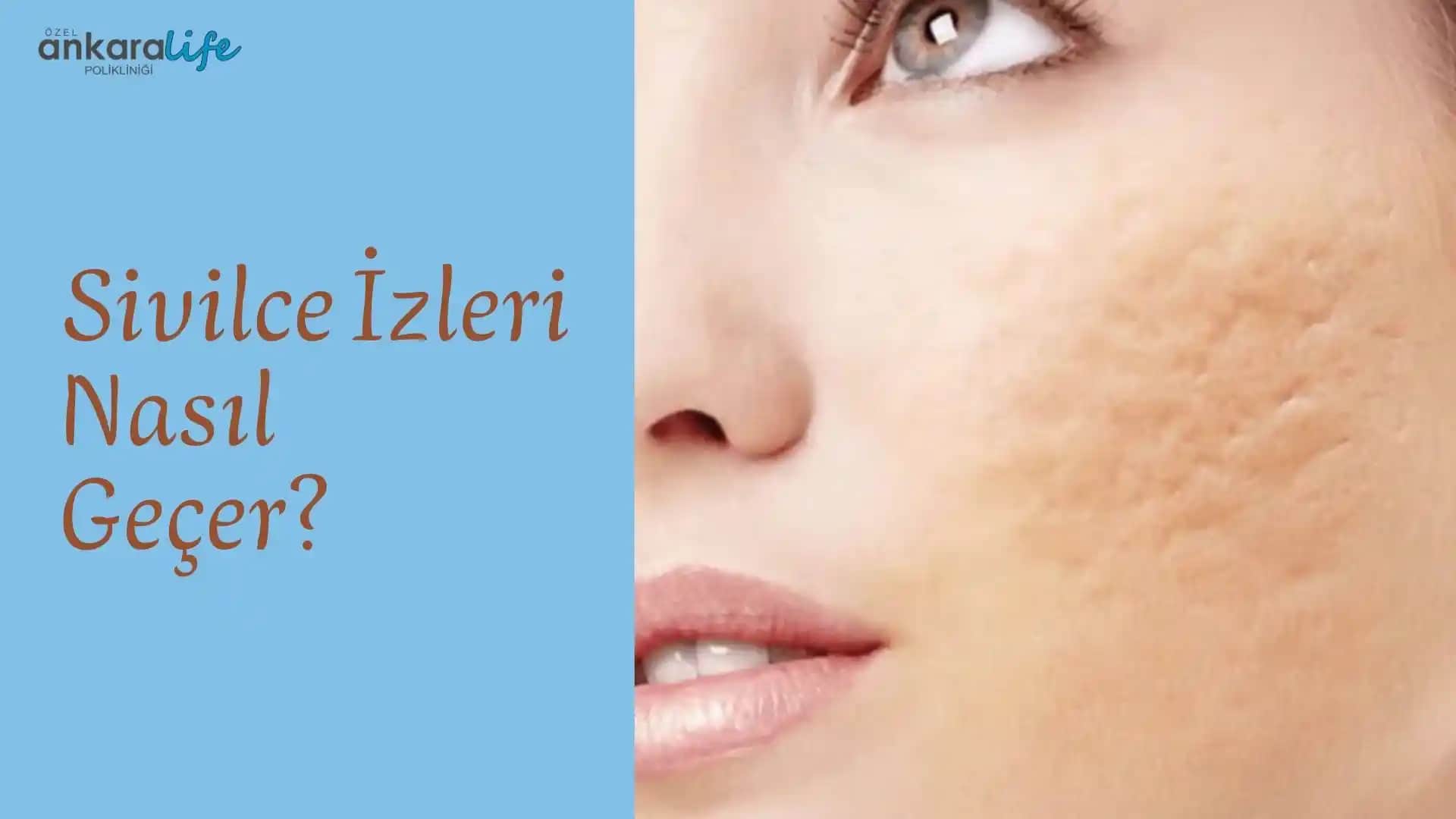 Eski Sivilce İzlerini Giderme Yöntemleri ve Cilt Yenileme İpuçları