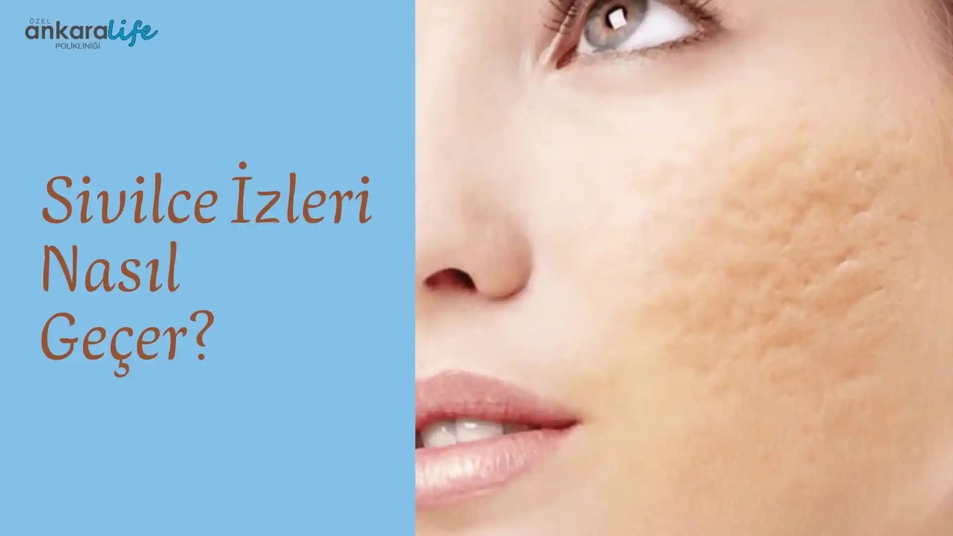 Eski Sivilce İzlerini Giderme Yöntemleri ve Cilt Yenileme İpuçları