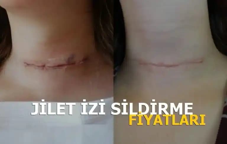 Evde Jilet İzi Giderme Yöntemleri ve Doğal Çözüm Tavsiyeleri