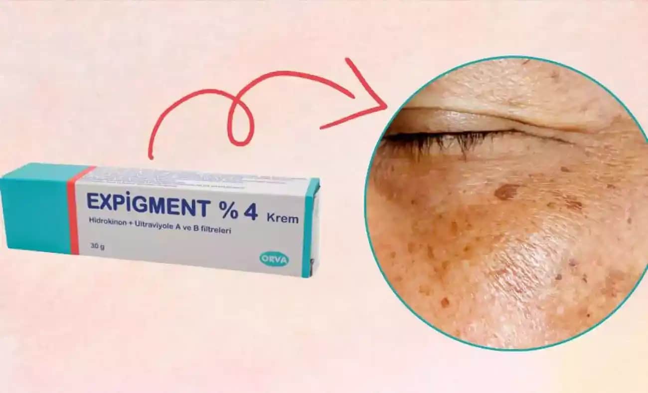 Expigment Jel ile Cilt Tonunu Eşitleme ve Lekeleri Azaltma Rehberi