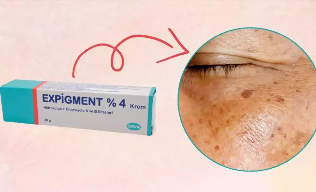 Expigment Jel ile Cilt Tonunu Eşitleme ve Lekeleri Azaltma Rehberi