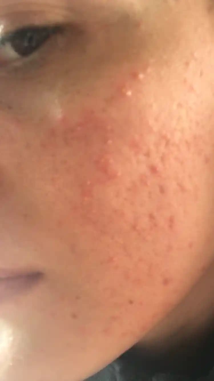 Fungal Sivilce Nedir, Belirtileri ve Kozmetik Yaklaşımlarla Tedavi Yöntemleri