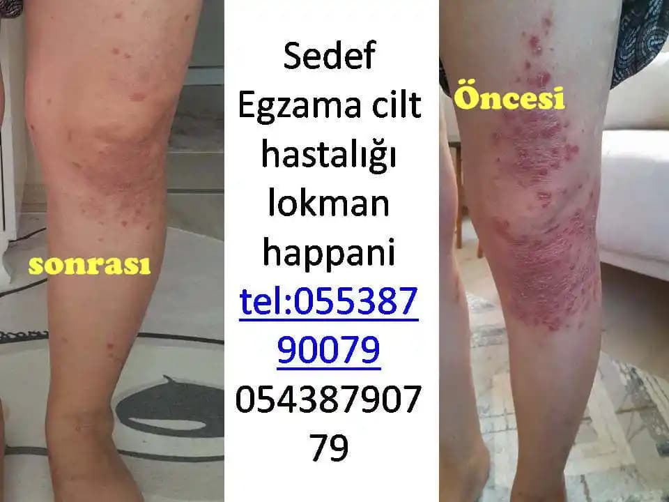 Gavur Pancar Kremi ile Sedef Hastalığında Doğal ve Yan Etkisiz Çözüm Alternatifleri