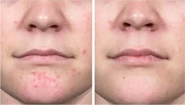 Geçmeyen Kistik Sivilceler İçin Nedenler, Çözüm Yolları ve Kozmetik Yaklaşımlar