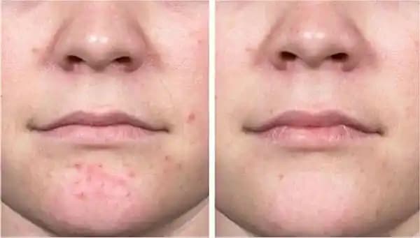 Geçmeyen Kistik Sivilceler İçin Nedenler, Çözüm Yolları ve Kozmetik Yaklaşımlar