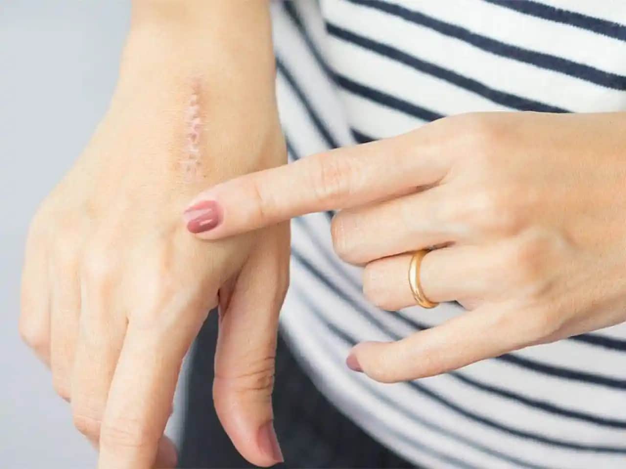 Geçmeyen Yara İzleri ve Kozmetik Yöntemlerle Etkili Tedavi Seçenekleri