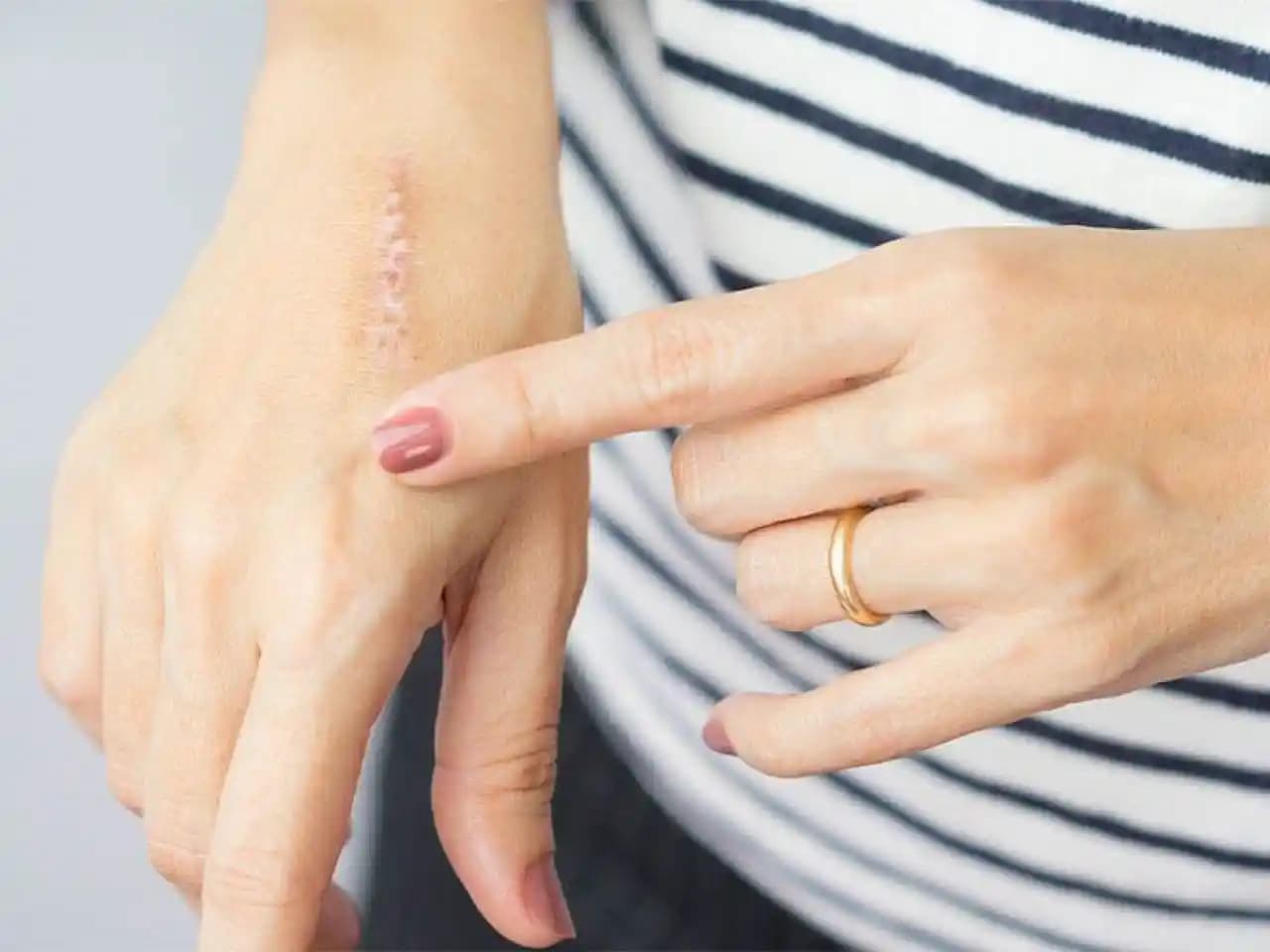 Geçmeyen Yara İzleri ve Kozmetik Yöntemlerle Etkili Tedavi Seçenekleri