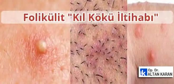 Genital Bölgede İltihaplı Batıklar: Nedenleri, Belirtileri ve Etkili Önleme Yöntemleri