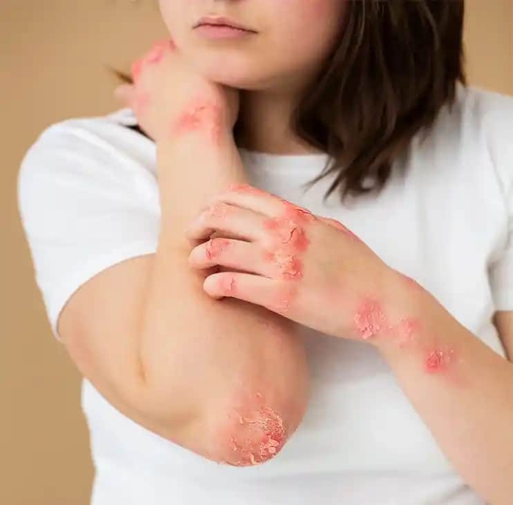 Göğüs Arası Egzama Nedir, Nedenleri ve Cilt Sağlığını Koruma Yolları