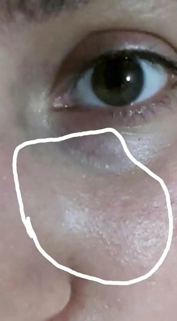 Göz Altı Beyaz Noktaları Nedenleri, Çözüm Yolları ve Bakım İpuçları