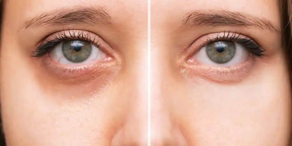 Göz Altı Çizgileri İçin Doğal ve Etkili Yöntemler: Cilt Sağlığını Koruma Rehberi