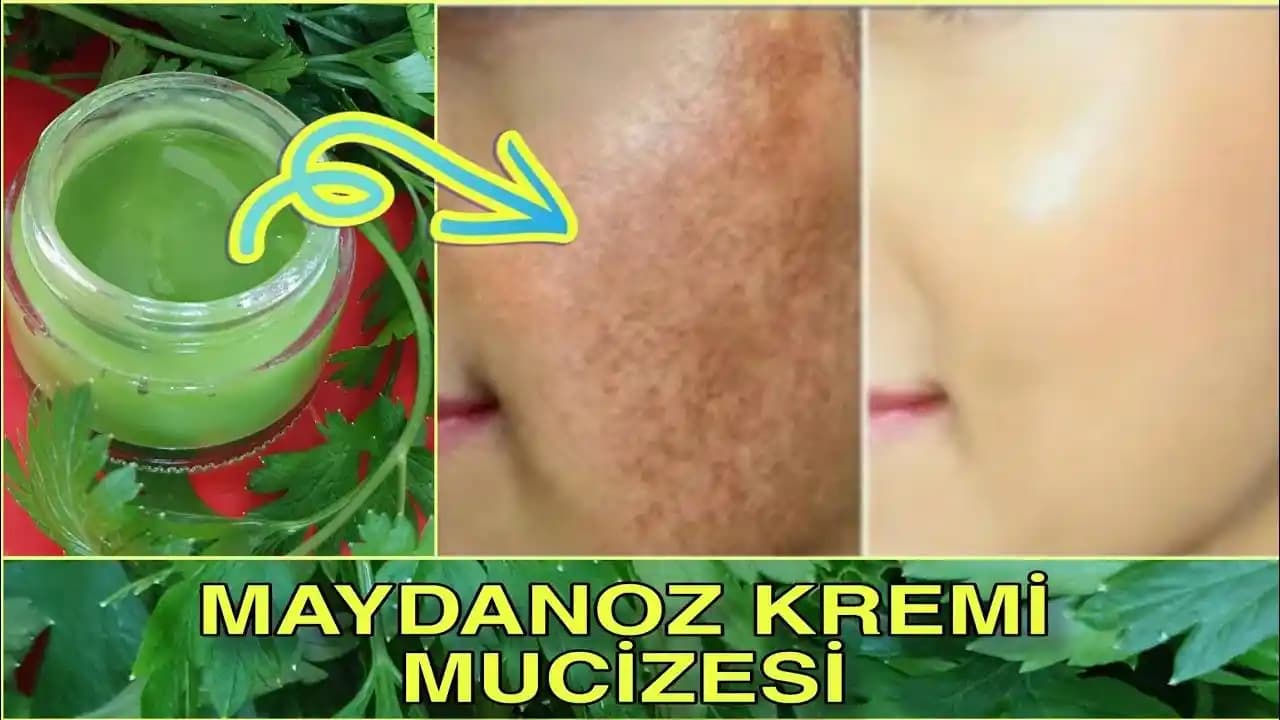 Göz Altı Güneş Lekeleri: Nedenleri, Tedavi Yöntemleri ve Koruma İpuçları