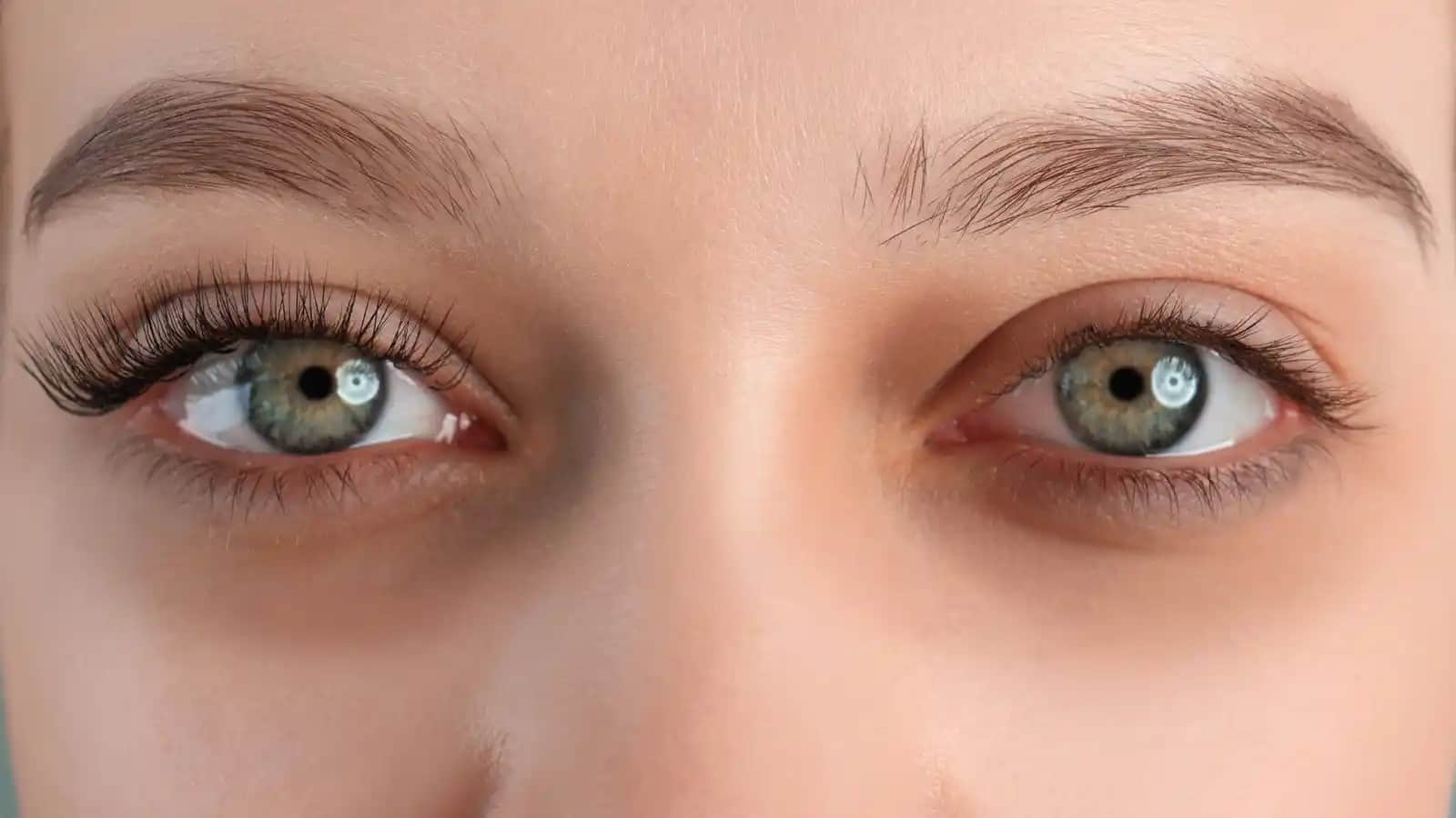 Göz Altı Halkalarını Azaltmanın Etkili Yöntemleri ve Doğal Çözüm İpuçları